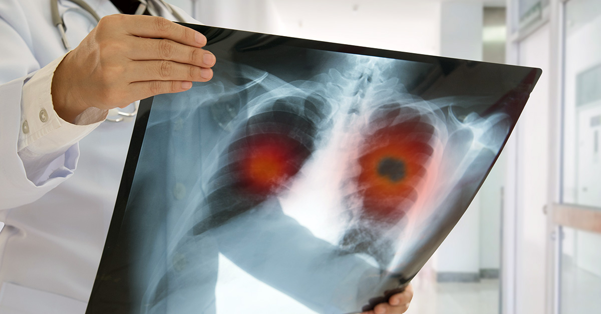 doctor holding up a lung xray
